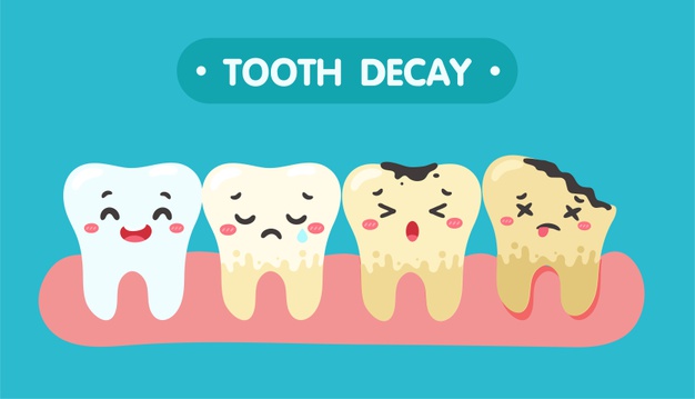 Cartoon teeth progressively showing tooth decay.