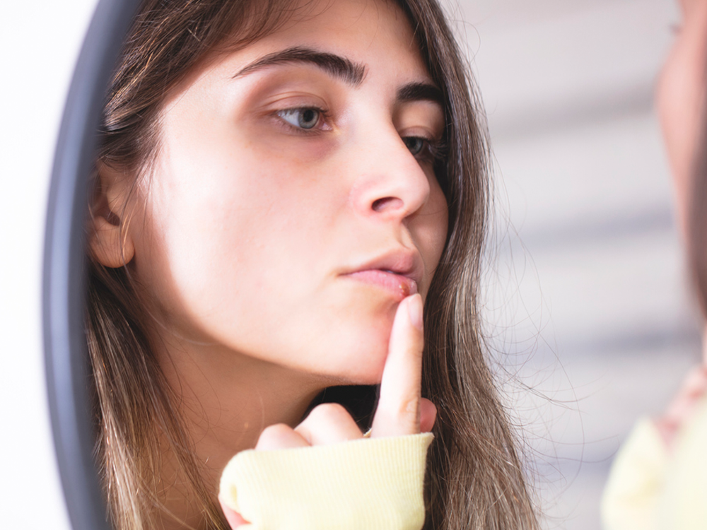 Cold Sore Treatment