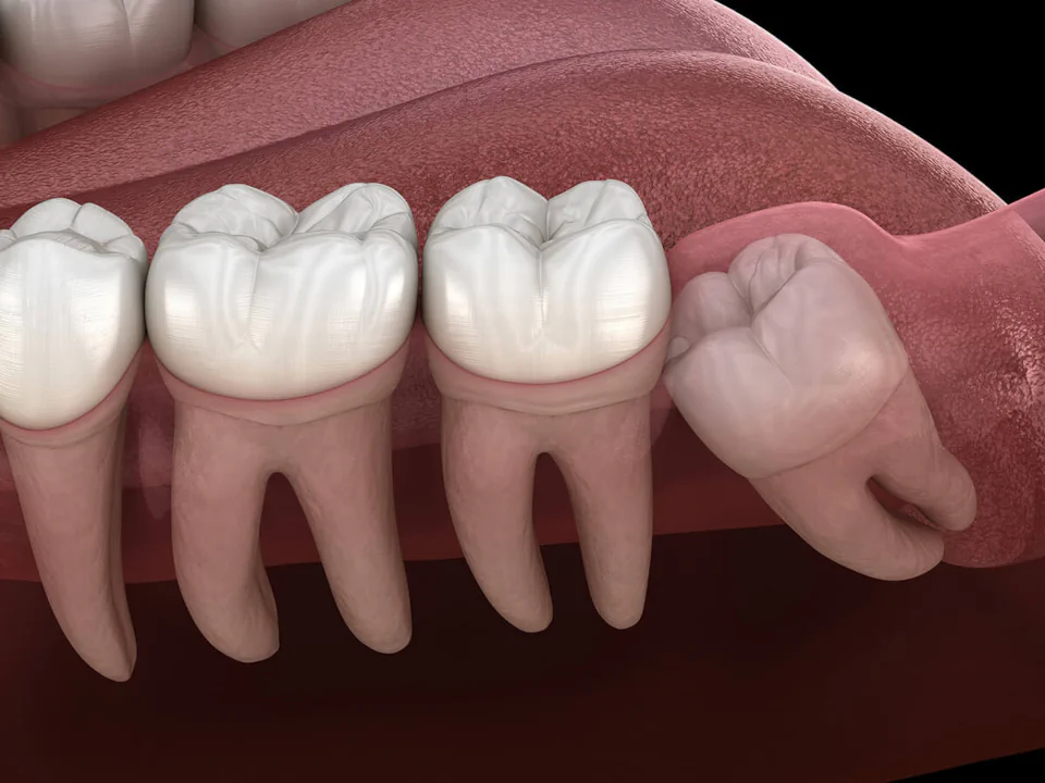 Wisdom teeth removal in Wichita, KS at Humlicek Dental.