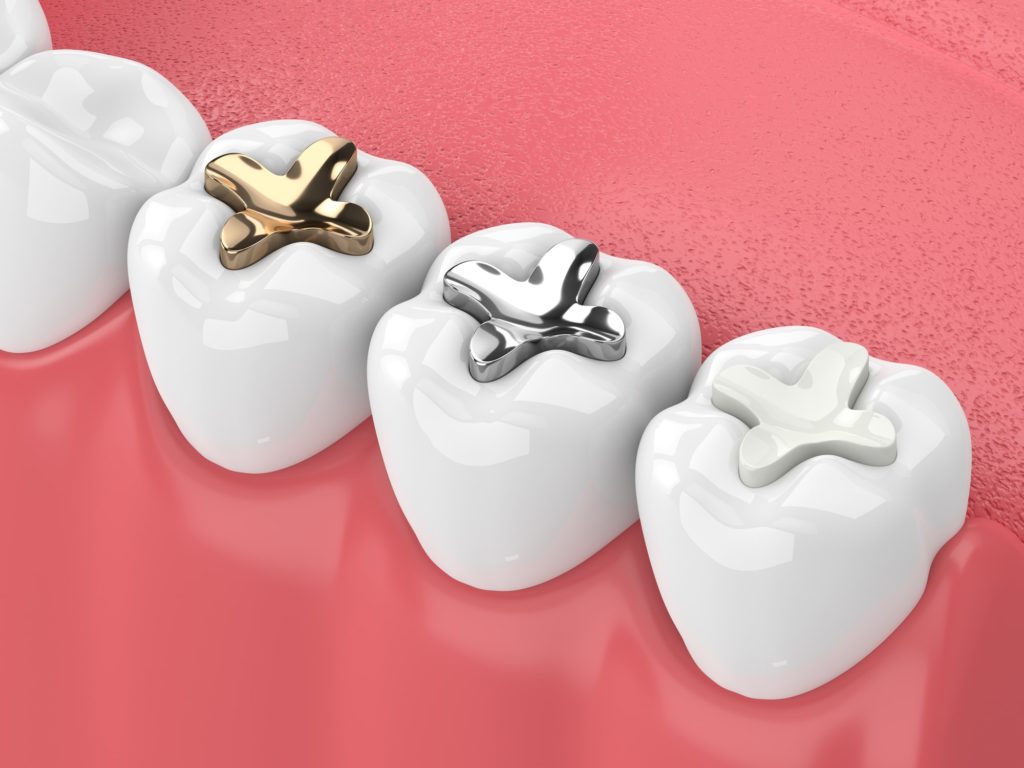Illustration of a row of teeth showing different types of dental fillings
