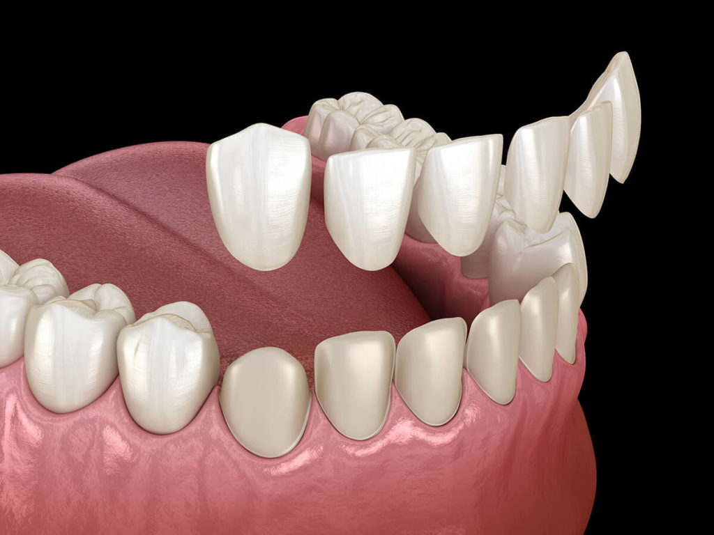 picture of mouth with veneers being placed on teeth