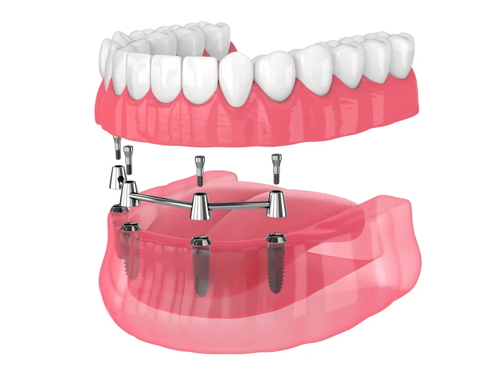 An illustration of a dental implant-supported denture. The image shows the upper and lower dentures with metal implants and abutments fixed into the gums, providing support for the dentures. The upper denture is shown above, while the lower denture is below, with metal bars connecting the implants.